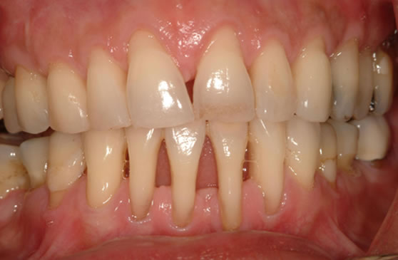 What is Periodontal (Gum) Disease