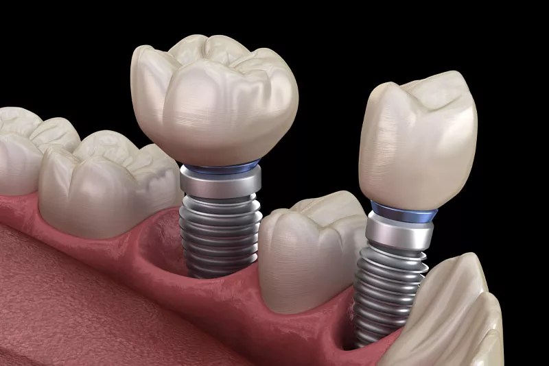 Dental Implants Full Mouth Dental Implants Herndon, VA