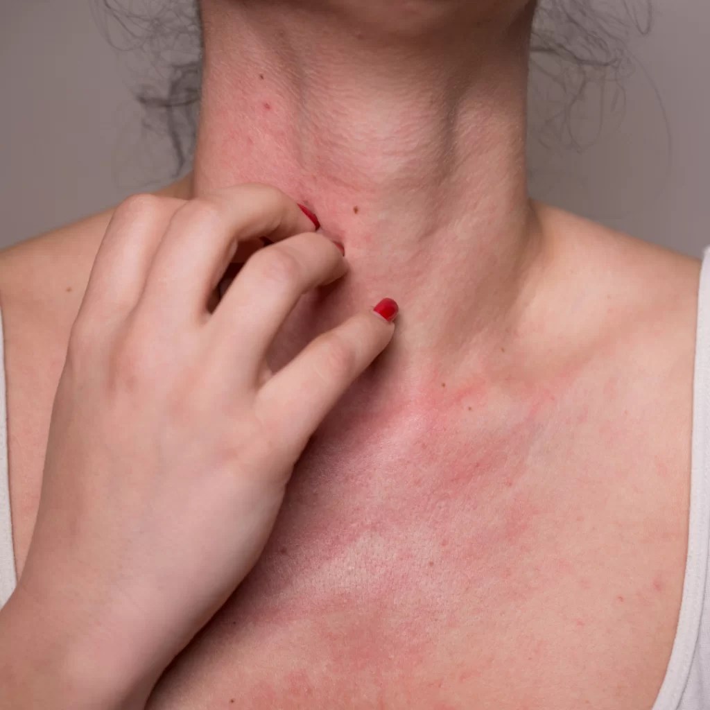 Blood Test Vs. Skin Test For Allergies Which One Should You Get?