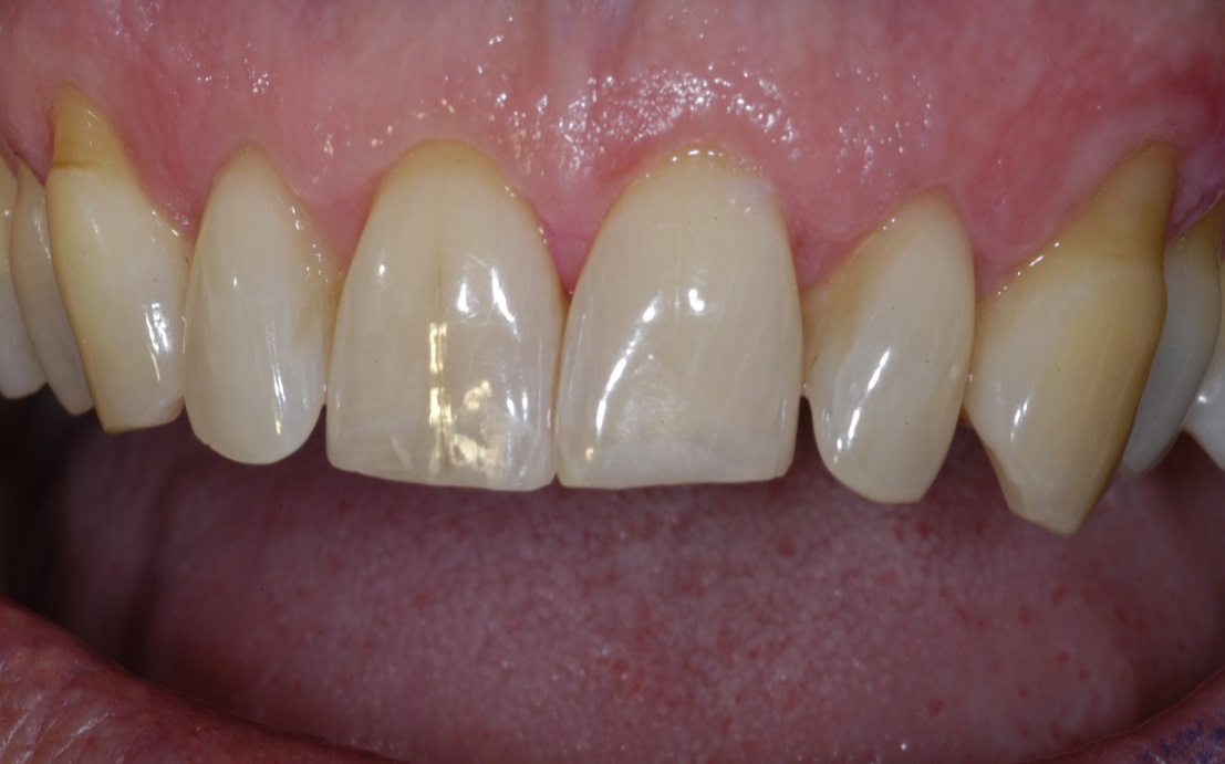 INCISAL MAXILLARY LINGUOINCISAL Peter Walford Dentistry