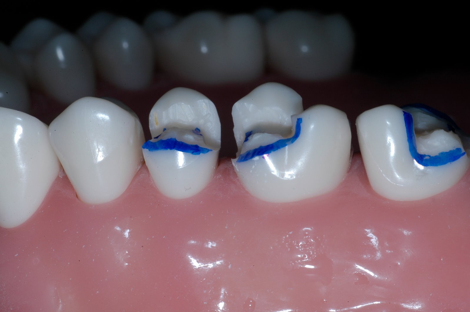CAVOSURFACE BEVELS WITH 7404 AND 7406 BURS Peter Walford Dentistry