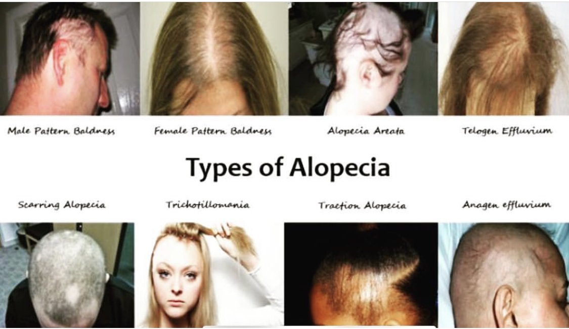 Treatment for Alopecia at Philadelphia Homeopathic Clinic by Dr. Tsan