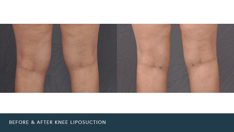 Knee Liposuction Phoenix Liposuction Phoenix Liposuction
