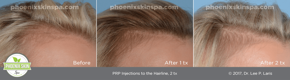 Platelet Rich Plasma for Hair Loss Phoenix Skin Spa
