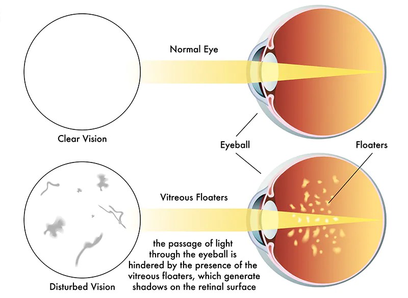 เห็นจุดดำ เวลามอง คืออาการอะไร? โรงพยาบาลกรุงเทพภูเก็ต