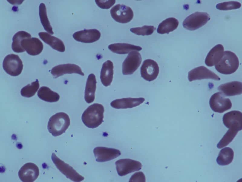LGlutamine Reduces Number of Pain Crises in Sickle Cell Disease