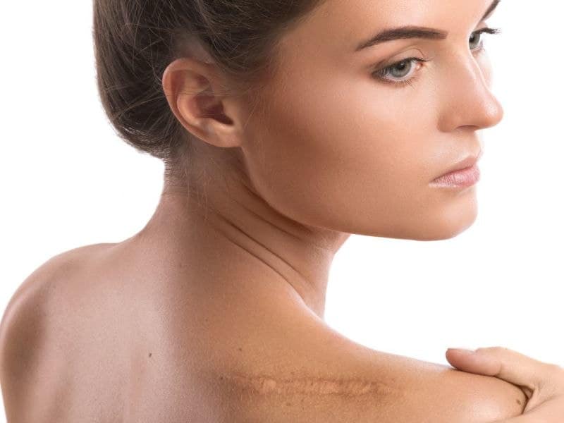 Fractional CO2 Laser Treatment for Burn Scars Physician's Weekly