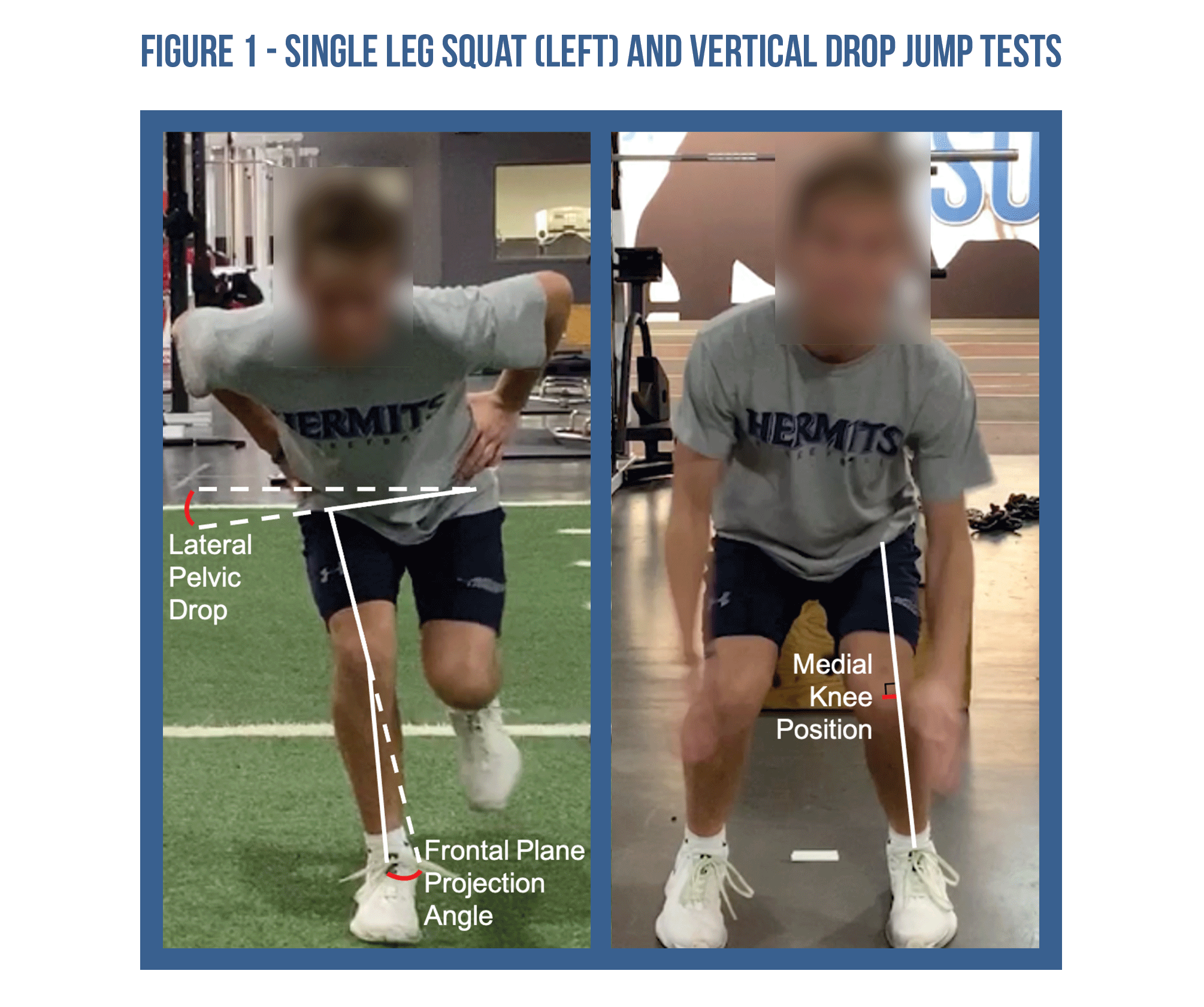 Do ‘kissing Knees’ Increase The Risk Of ACL Injury? — Physio Network