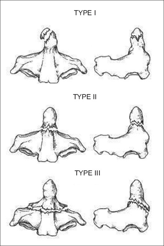 Odontoid fractures Physiopedia