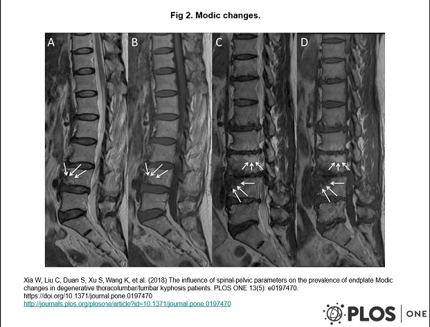Modic Changes Physiopedia