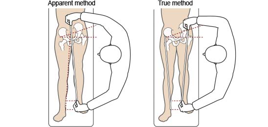 Leg Length Discrepancy Physiopedia