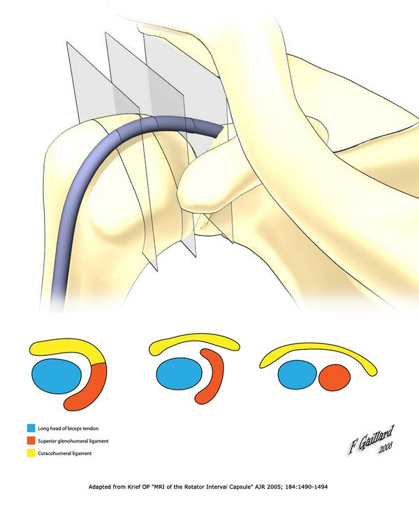 Shoulder Instability Physiopedia
