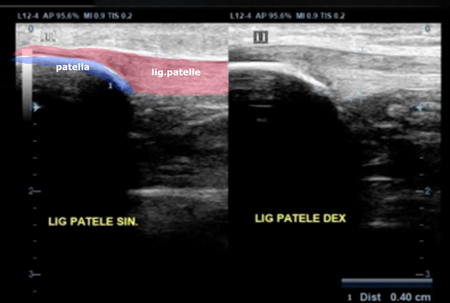 Jumper's knee MSK Ultrasound Physiotherapy News