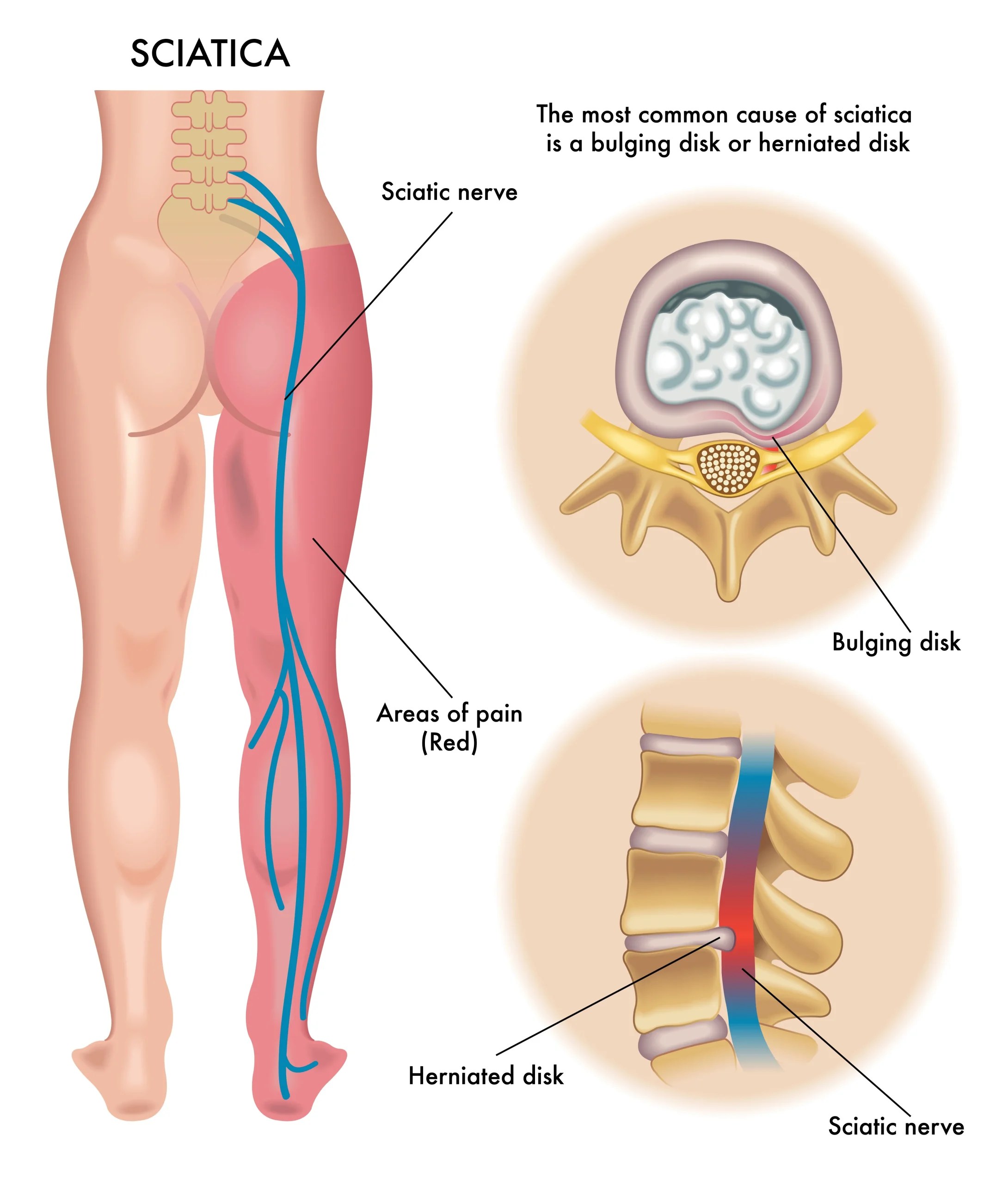 My back hurts , but why is my leg tingling? PhysioFit