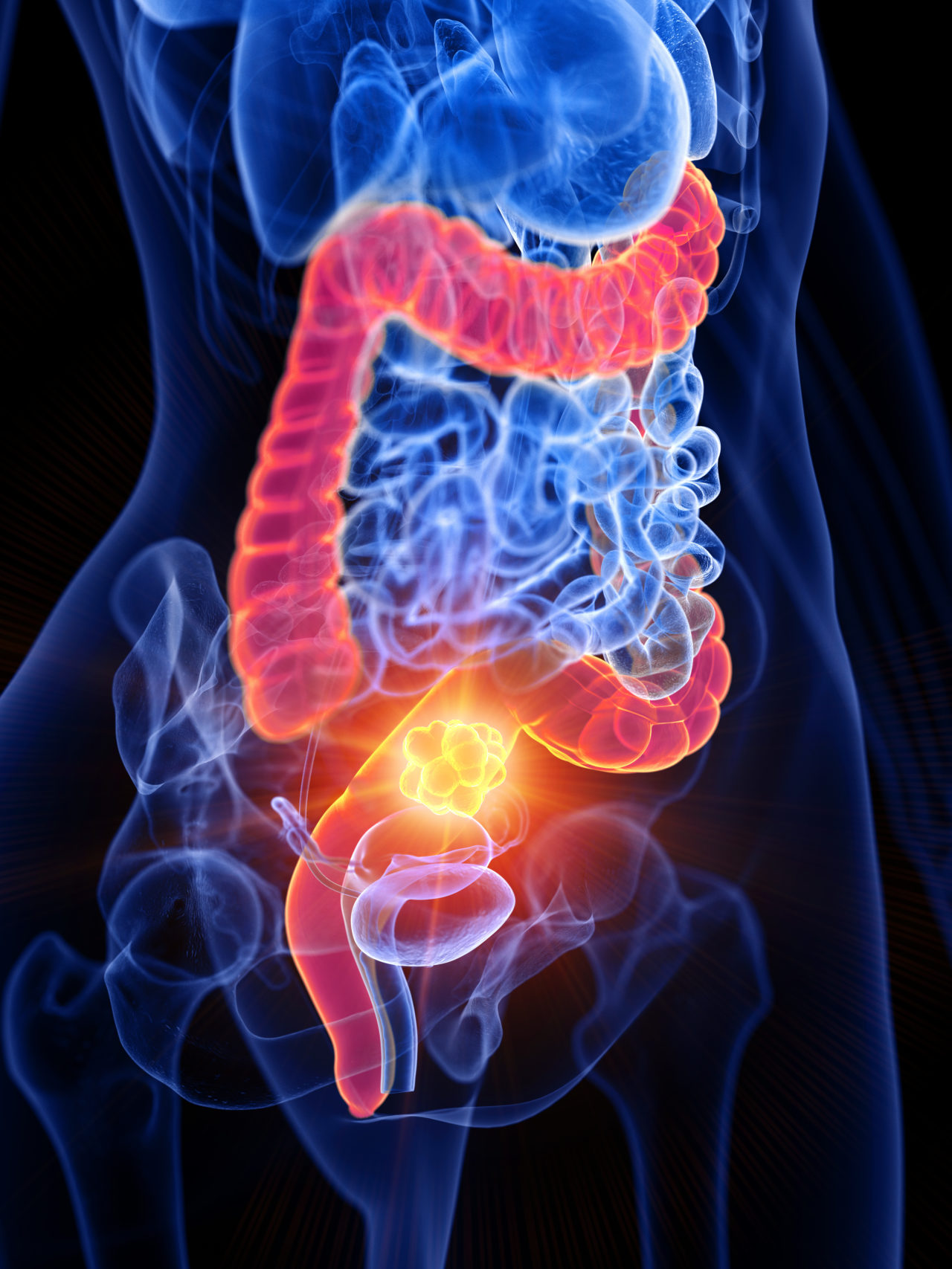 [DIAGRAM] Diagram Of Colitis