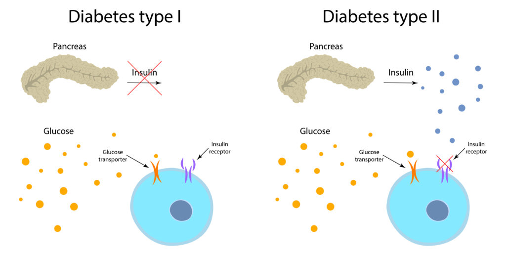 2023 Life Insurance with Type 1 and Type 2 Diabetes PinnacleQuote