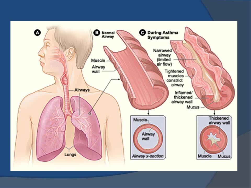 1000+ images about Asthma/COPD/Sleep Apnea on Pinterest Asthma, Lungs