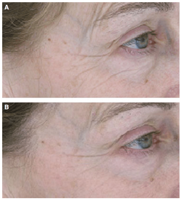 Bakuchiol Benefits for Skin a Potential Alternative to Retinol