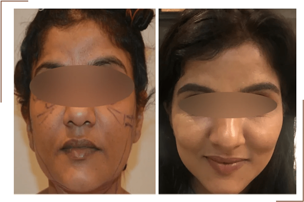 Best Facelift Surgery in Delhi Dr Monisha Kapoor