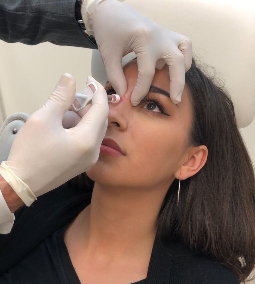 How a nonsurgical rhinoplasty can provide amazing results