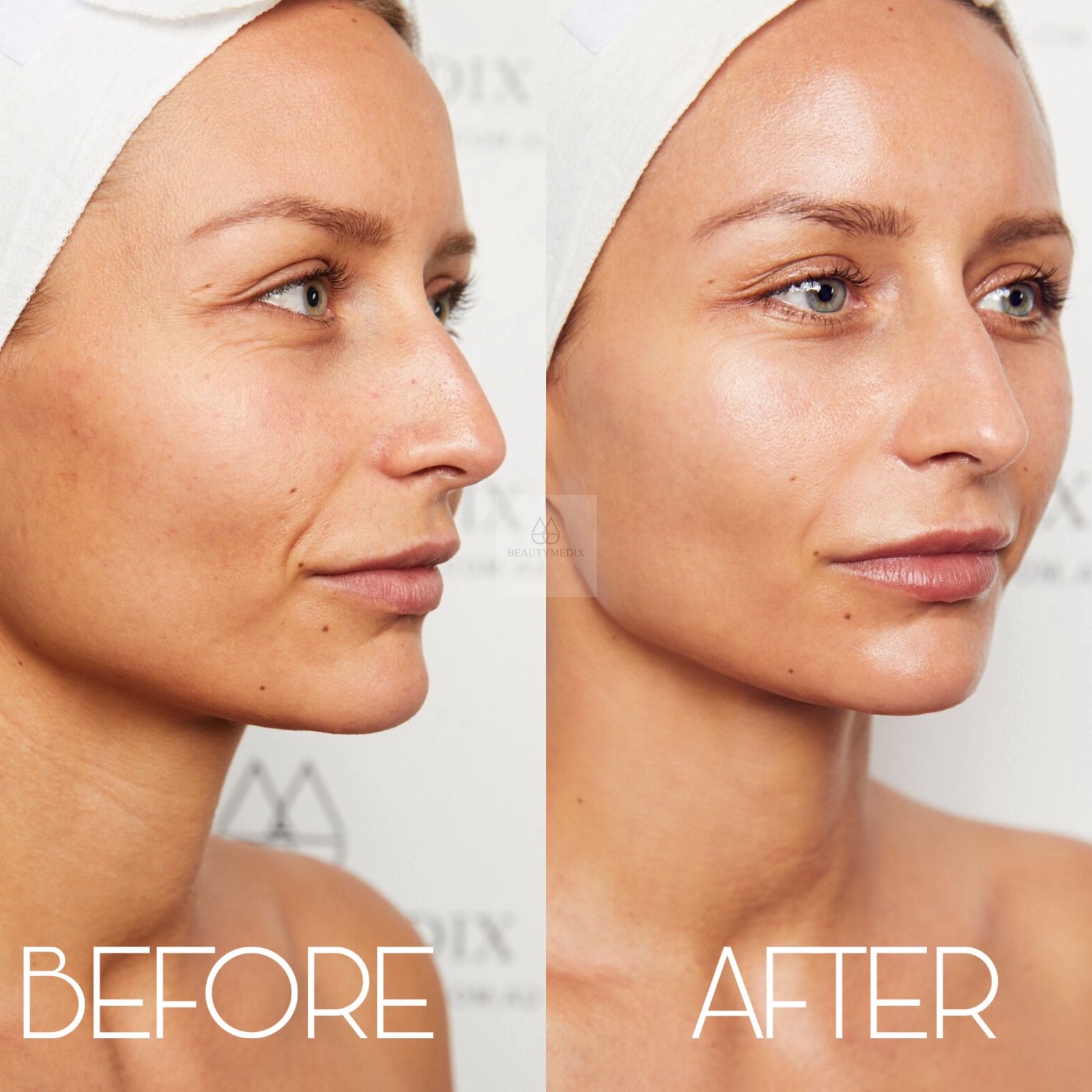 Vivace Microneedling Rejuvenation Results with BeautyMedix Vivace Microneedling Rejuvenation Results with BeautyMedix