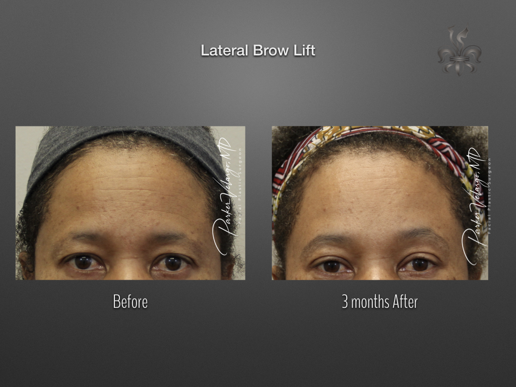 Brow Lift New Orleans New Orleans Center for Aesthetic and Plastic
