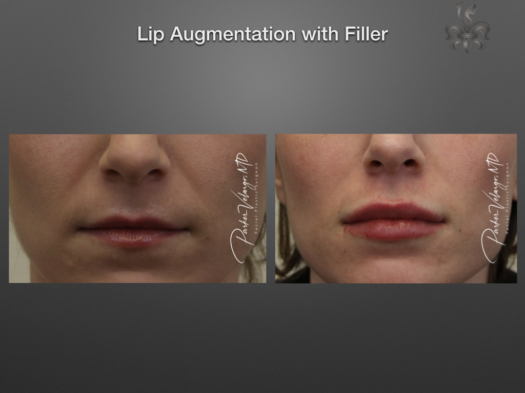 NonSurgical Lip Enhancement New Orleans Premier Center for