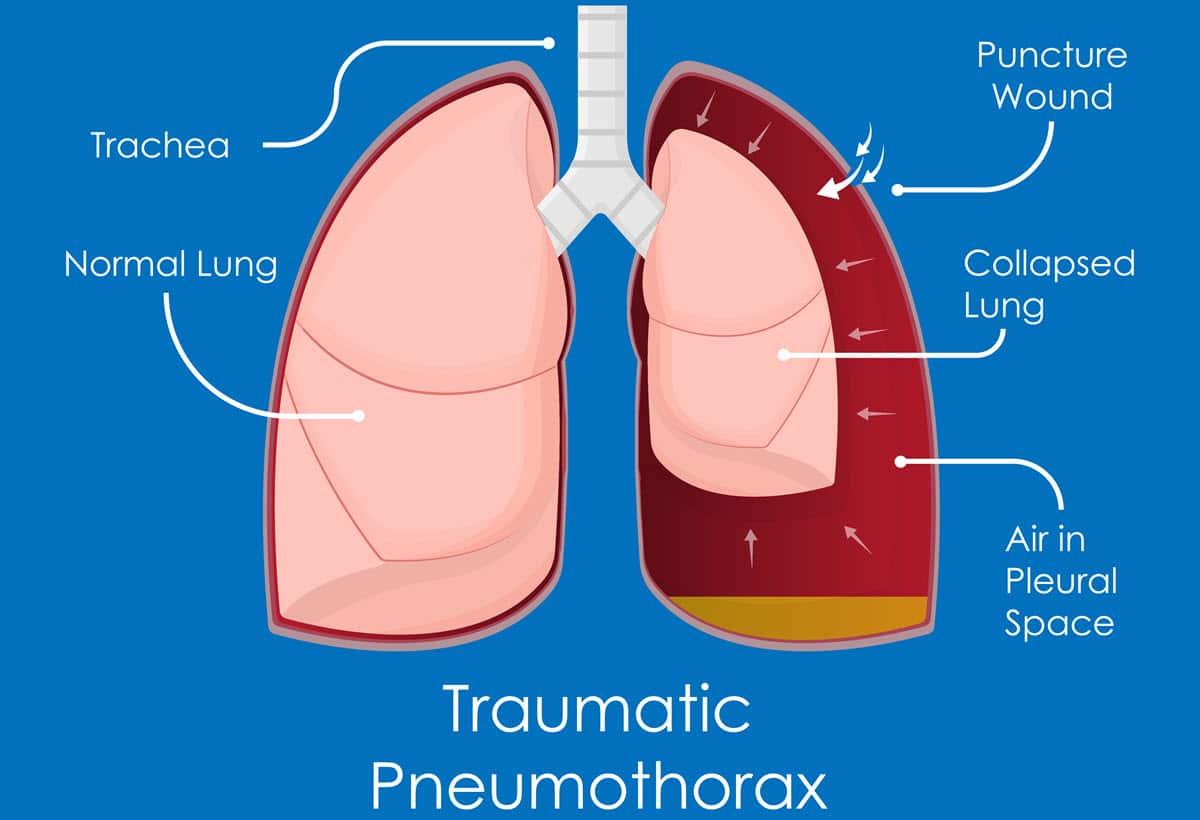 Acute Respiratory Distress Syndrome (ARDS) and Blunt Force Trauma