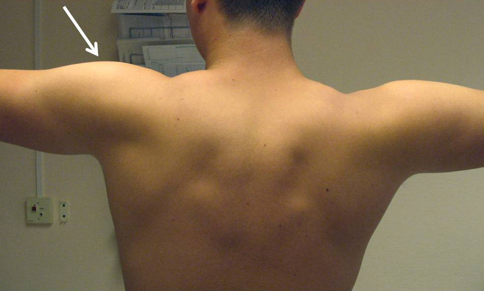 Andra nervskador Plexusskada