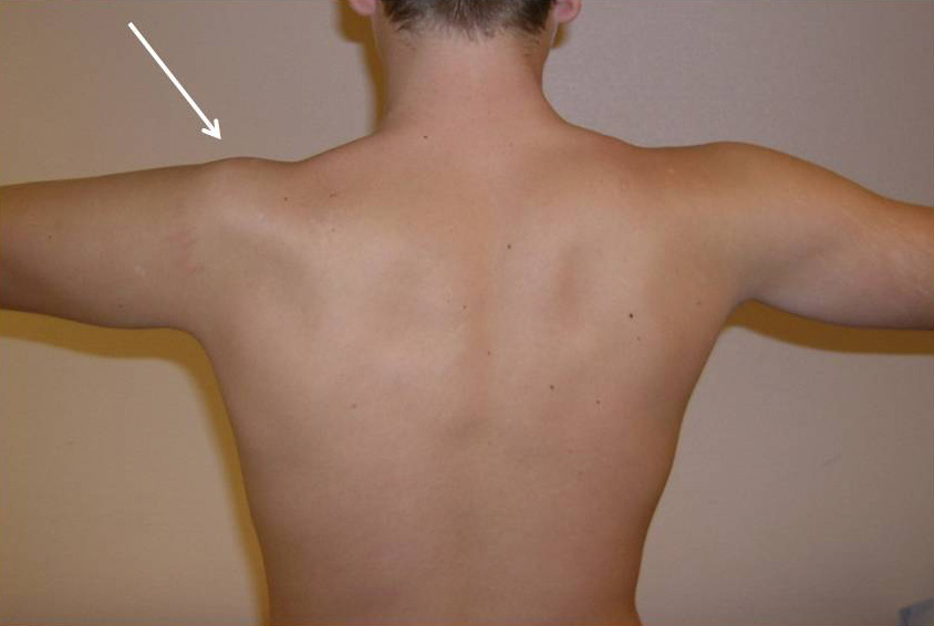 Andra nervskador Plexusskada