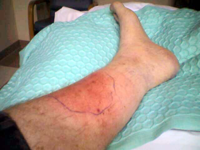 Do I have a blood clot? gout knee leg Ask MetaFilter