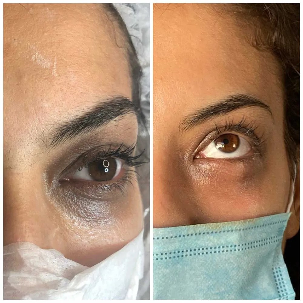 Permanent Concealer Before and After Gallery PMUHub
