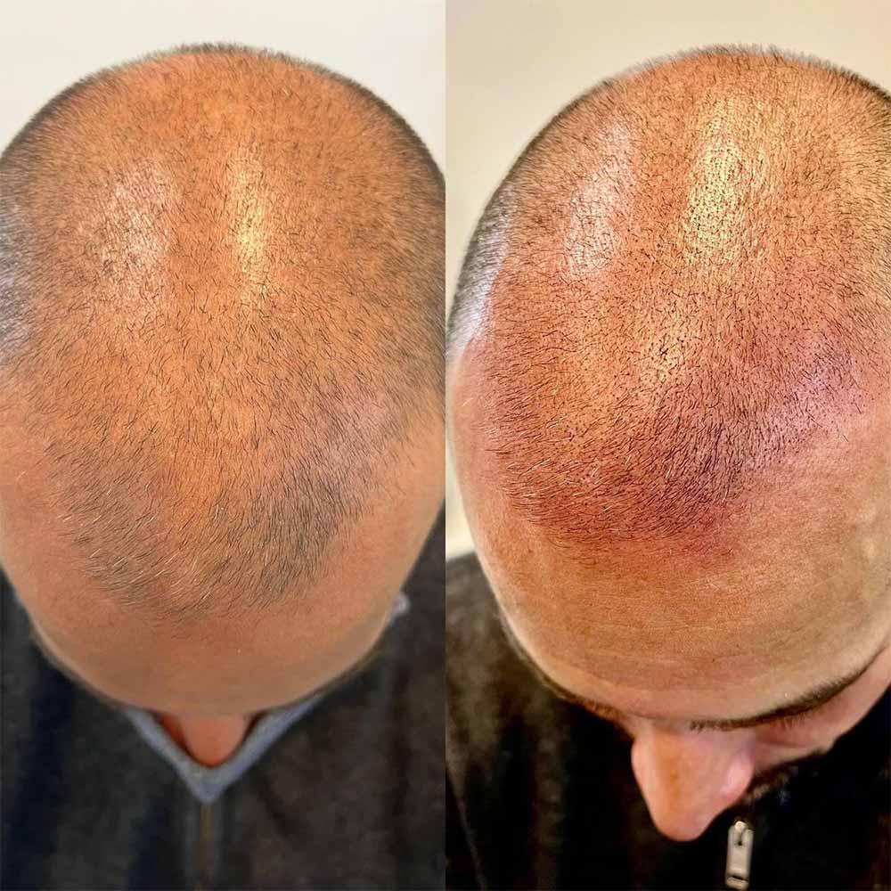 Scalp Micropigmentation Side Effects What’s Normal and What’s Not