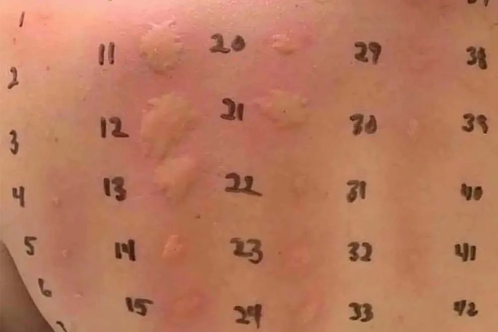 Microblading Patch Test Why You Should Always Do It