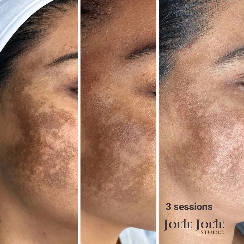 Microneedling Effects, Risks, Cost, Pain, Recovery, Before & After