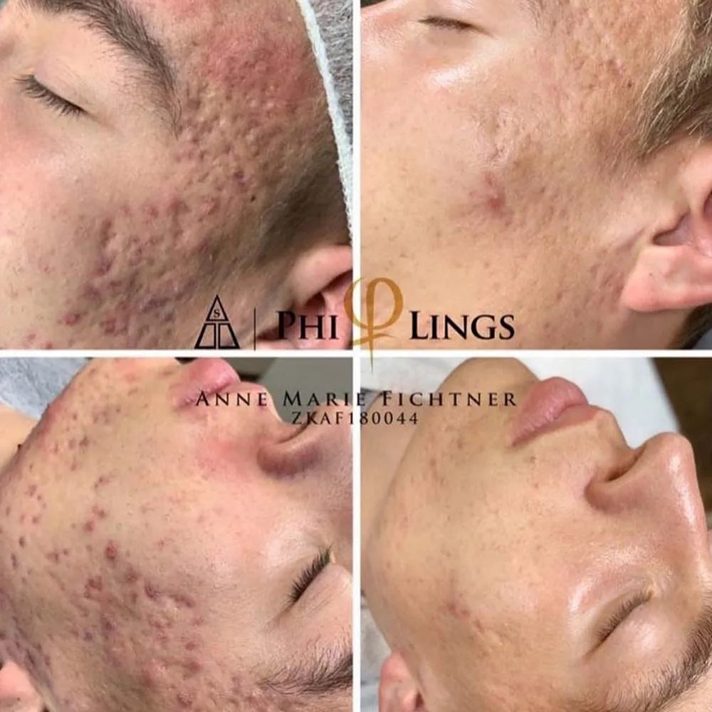 Microneedling Effects, Risks, Cost, Pain, Recovery, Before & After