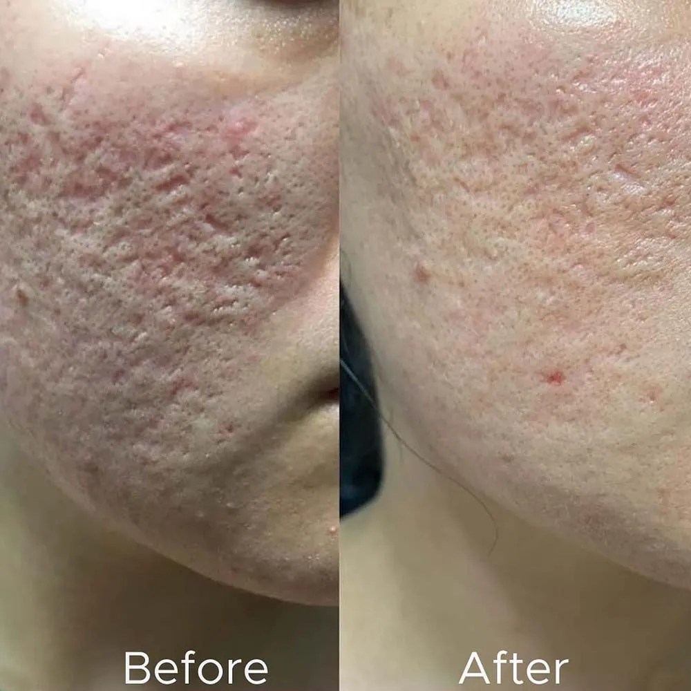 AtHome & Professional Derma Rolling All You Need to Know