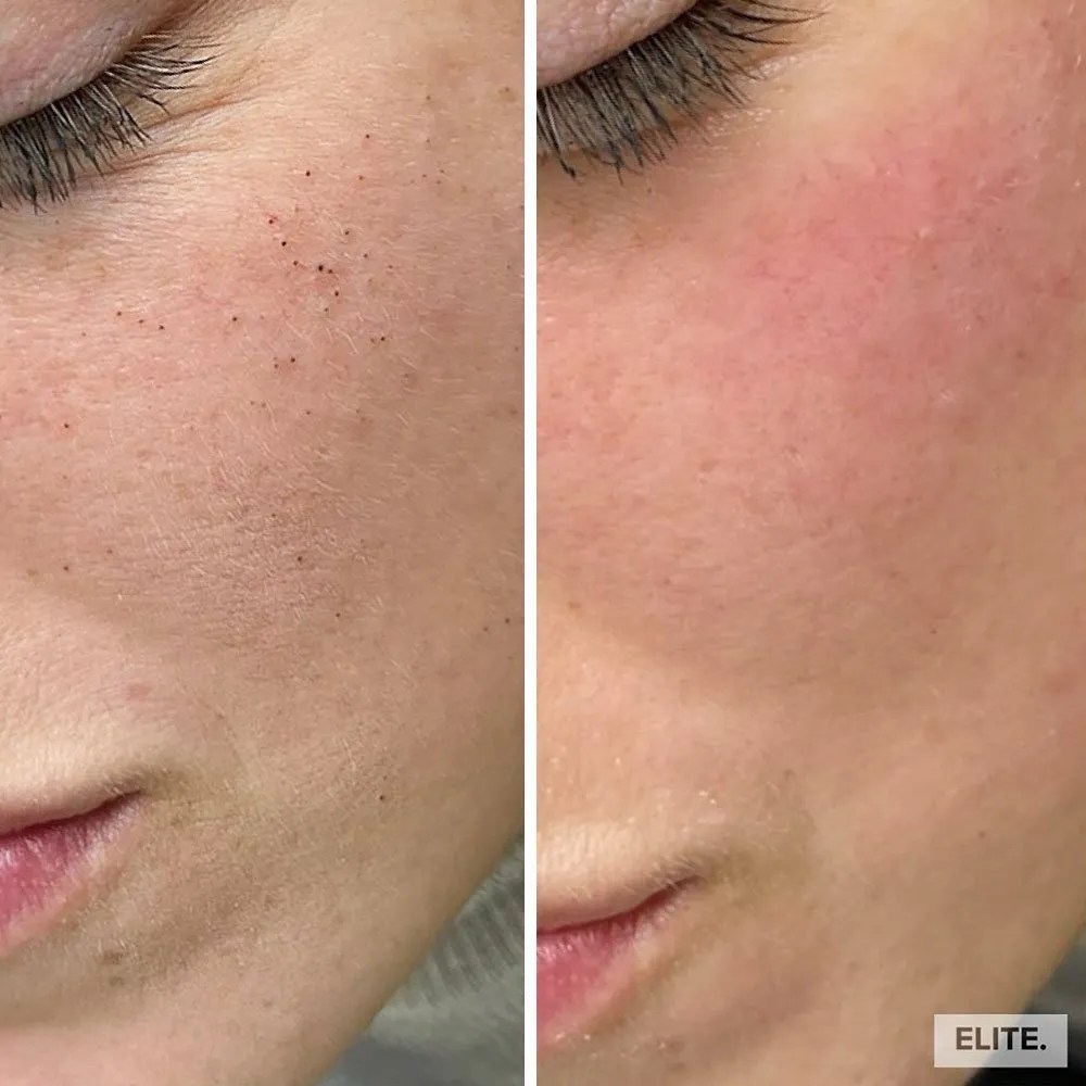 Microdermabrasion All You Need to Know About the Ultimate Facial