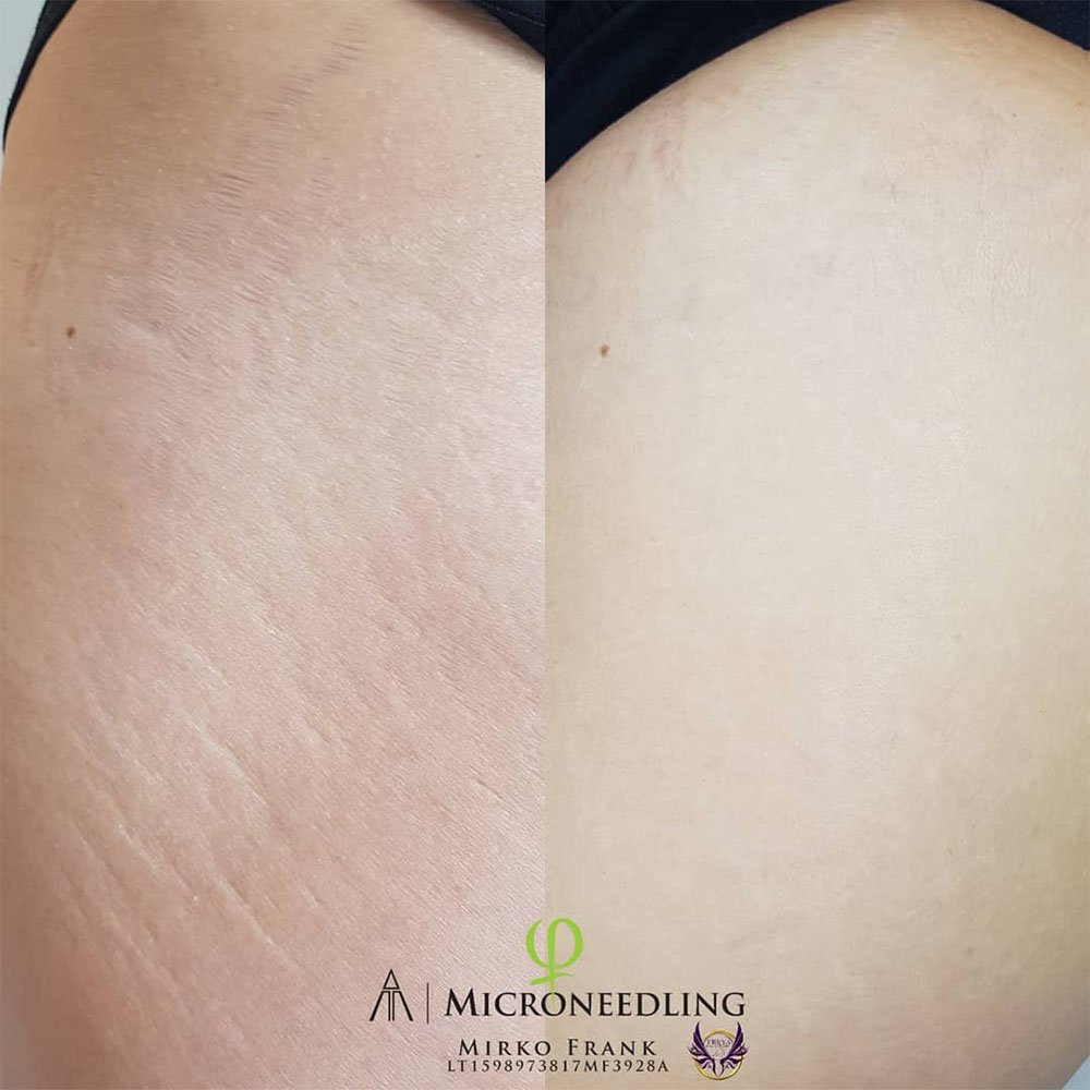 Microneedling Stretch Marks Does It Work and How?