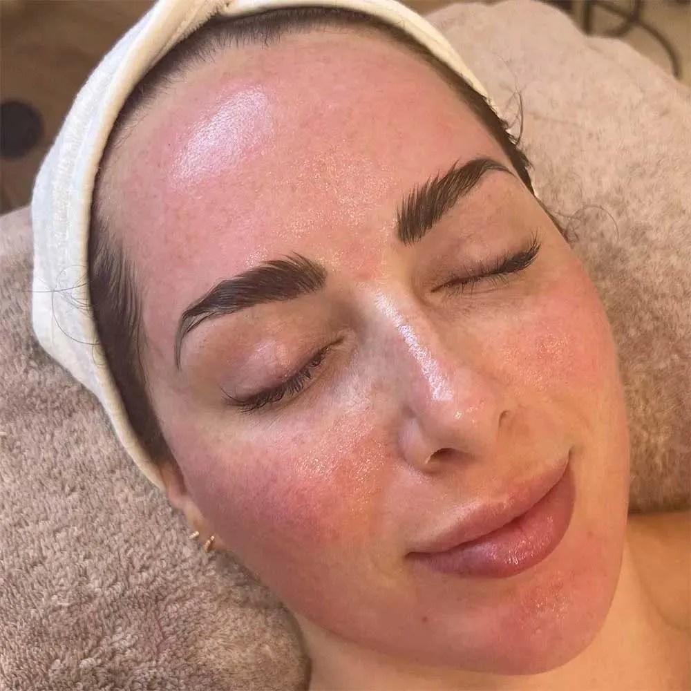 What Do Microneedling Healing Stages Look Like Day by Day