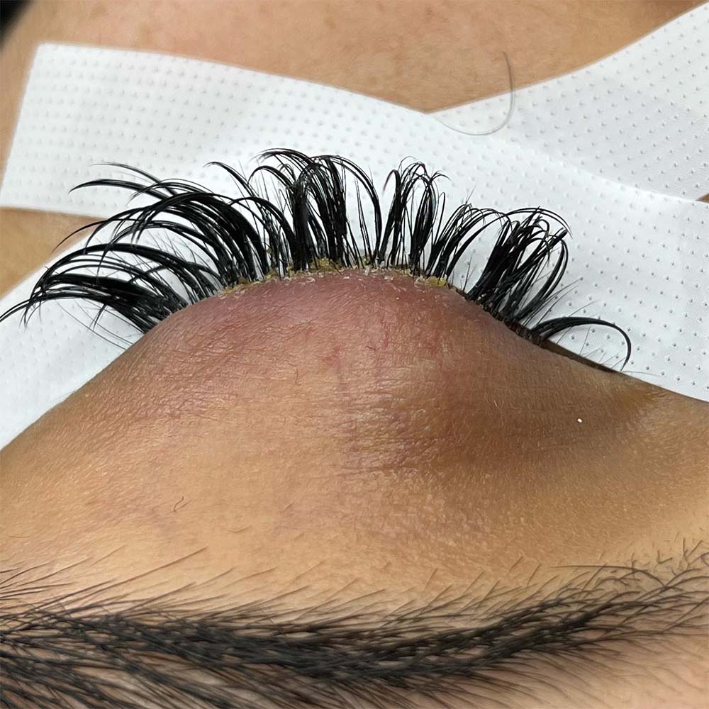 Can You Get Blepharitis from Eyelash Extensions?