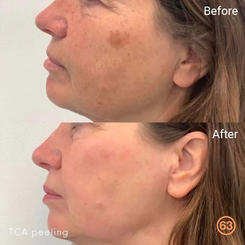 TCA Peel Everything You Need to Know Before Booking