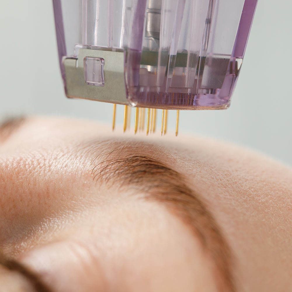 Microneedling Depth Guide Through Areas & Concerns
