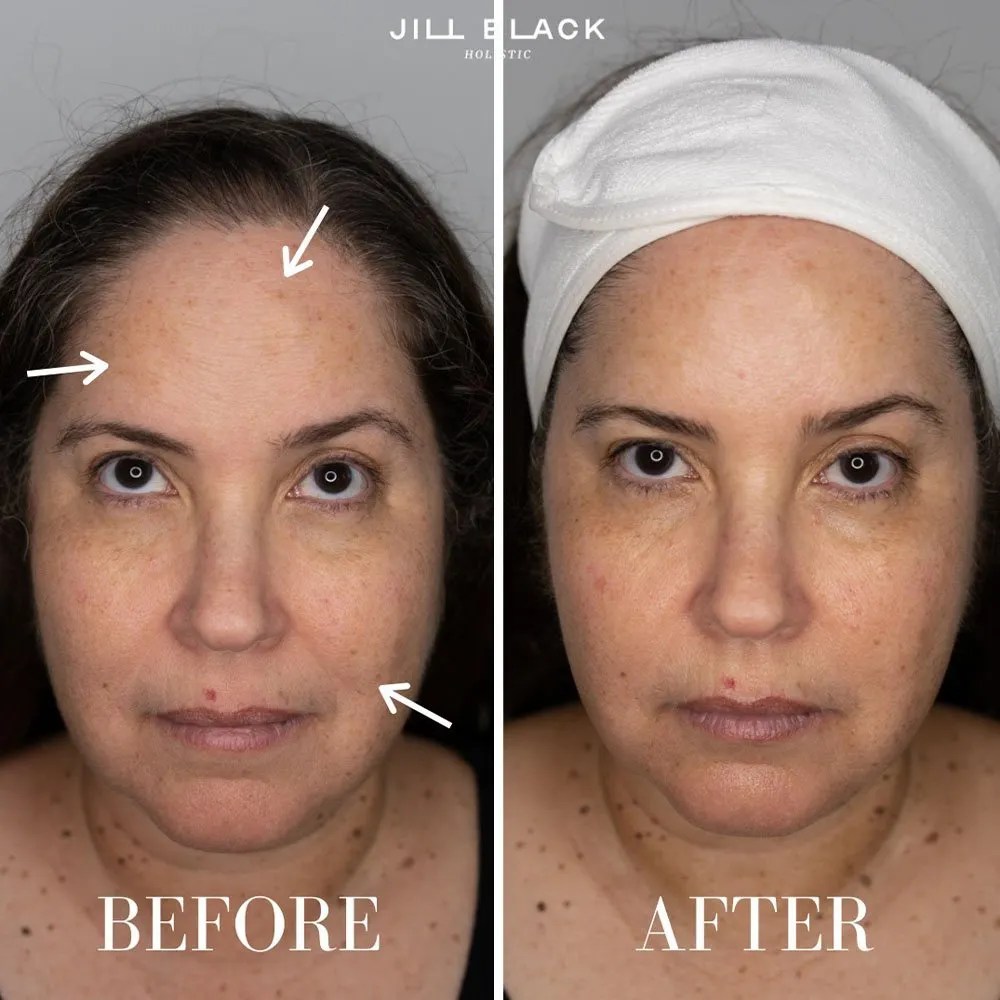 Microcurrent Facial All You Need to Know