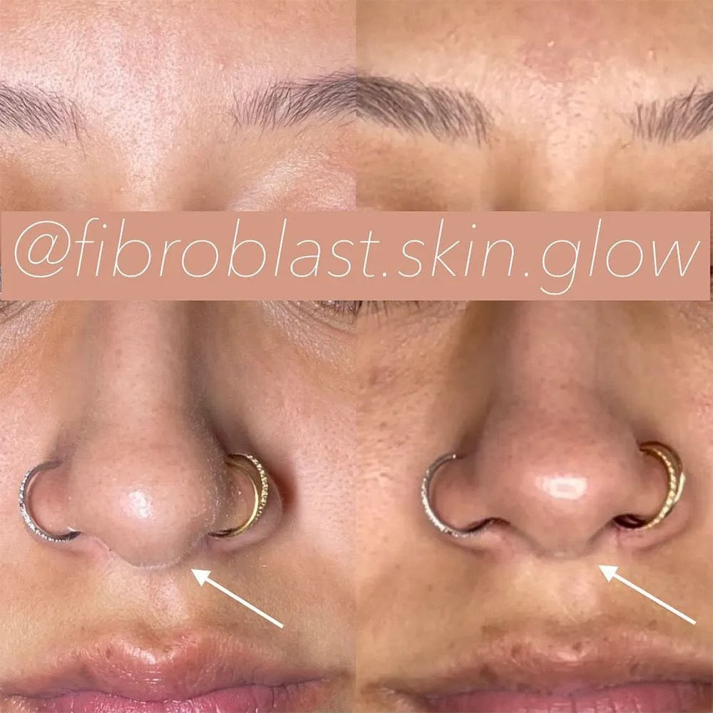Fibroblast Nose Job How It's Done and Does It Work?
