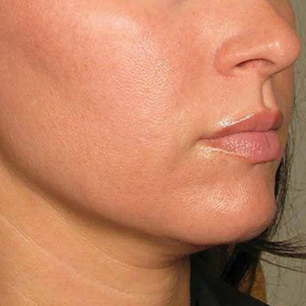 All You Need to Know About Radiofrequency for Skin