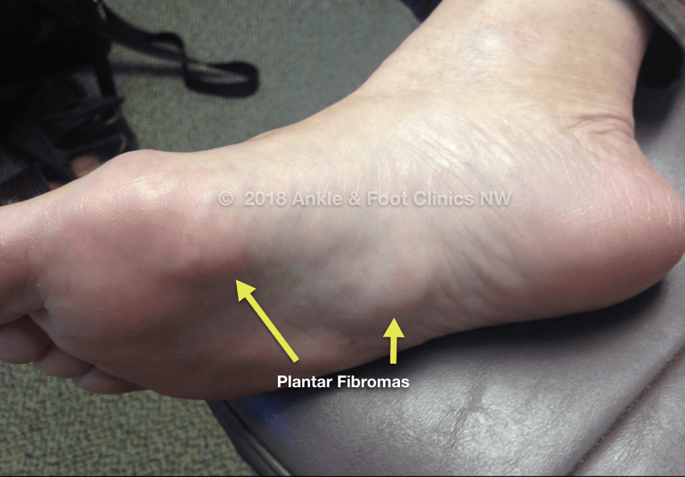 Plantar Fibroma Eastside Podiatry