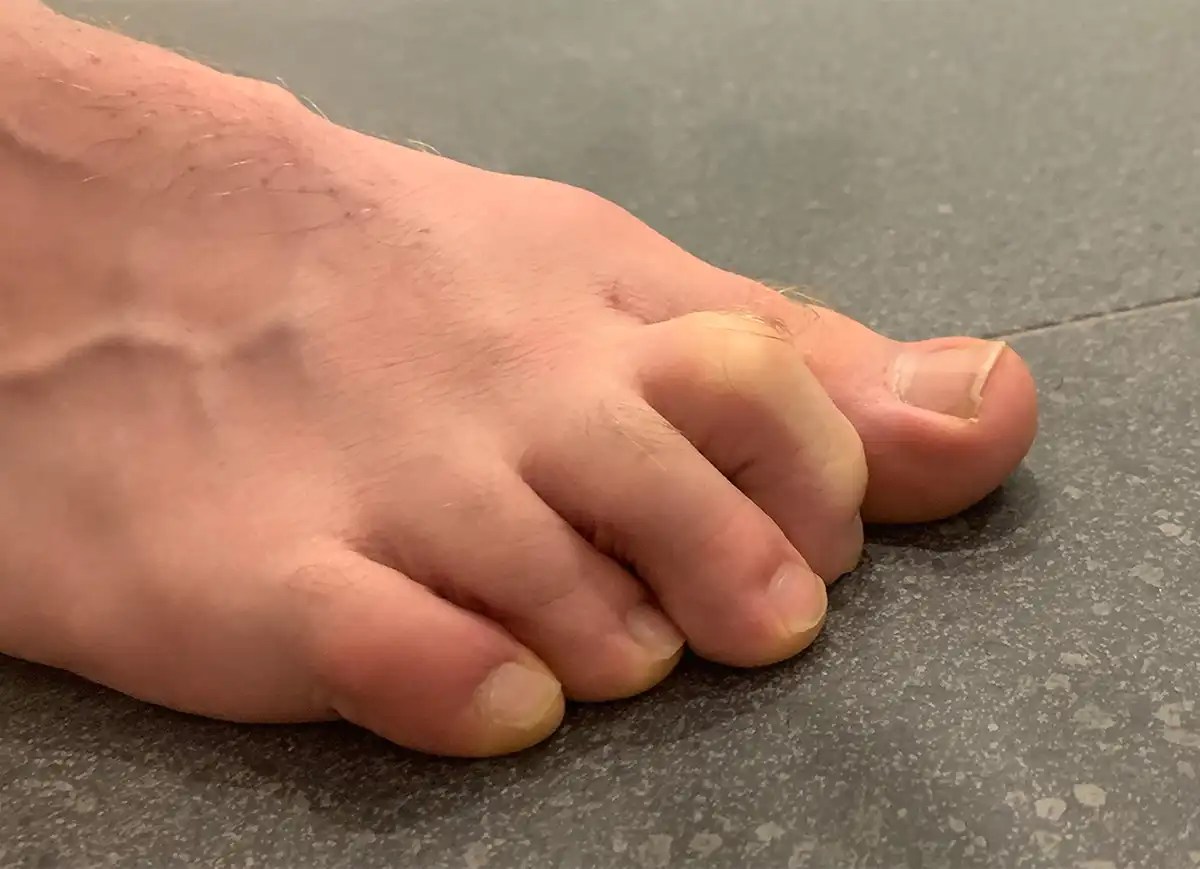 Claw toe neurological causes of this deformation Podexpert