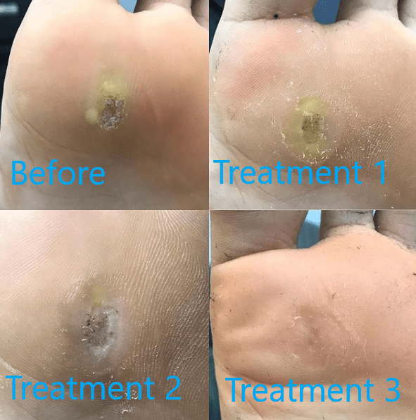 SWIFT WART TREATMENT Podiatrist Brisbane Southside The Podiatry