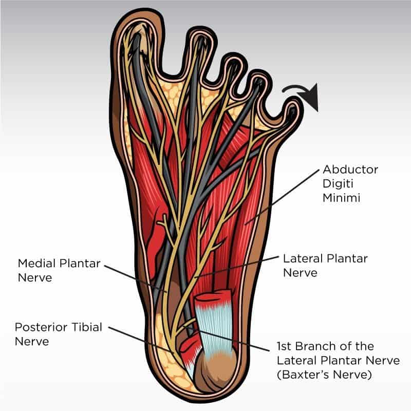 Neuropatía de Baxter Podowebinar